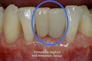 种牙还能当天戴牙？这三类人，千万别头脑一热