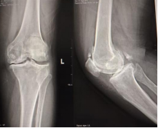 告别膝盖疼痛,重启活力人生——长治市中医医院全膝关节置换术助您迈向健康生活