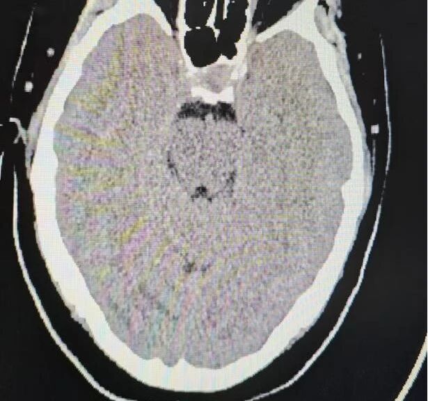 医院动态丨颅内静脉取栓再突破！喀地一院成功救治危重产妇，实现神经功能零缺损