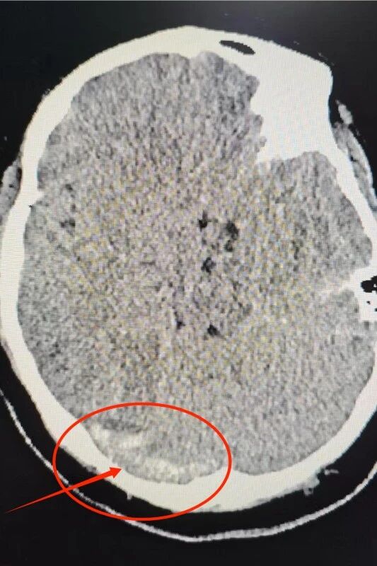 医院动态丨颅内静脉取栓再突破！喀地一院成功救治危重产妇，实现神经功能零缺损