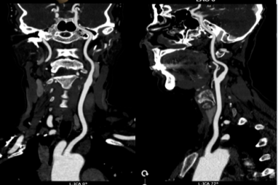典型病例 |「沉默炸弹」现形记：一位中年女性与脑动脉瘤的影像学交锋