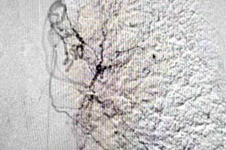 「喷射性咯血！医生临危不乱，微创介入化险为夷」