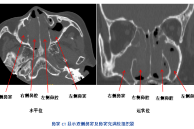 耳闷 + 听力暴跌！七旬奶奶多次治疗仍复发，真相竟藏在鼻子里…