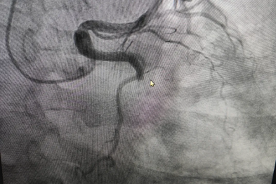 七旬老人胸闷两日命悬一线 心血管内科团队紧急介入转危为安