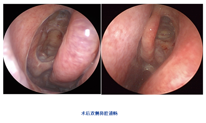 耳闷 + 听力暴跌!七旬奶奶多次治疗仍复发,真相竟藏在鼻子里…