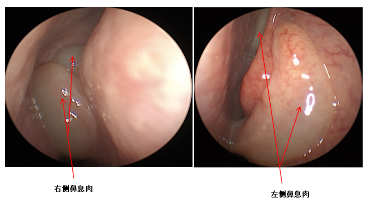 耳闷 + 听力暴跌!七旬奶奶多次治疗仍复发,真相竟藏在鼻子里…