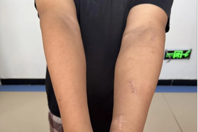 精准施策解难题，微创巧建「生命通道」——阳逻院区肾内科团队为肾衰患者成功实施特殊内瘘成形术