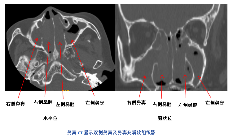 耳闷 + 听力暴跌!七旬奶奶多次治疗仍复发,真相竟藏在鼻子里…