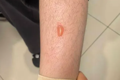 冬季保暖别踩坑！小心「隐形杀手」低温烫伤，比明火更难缠！