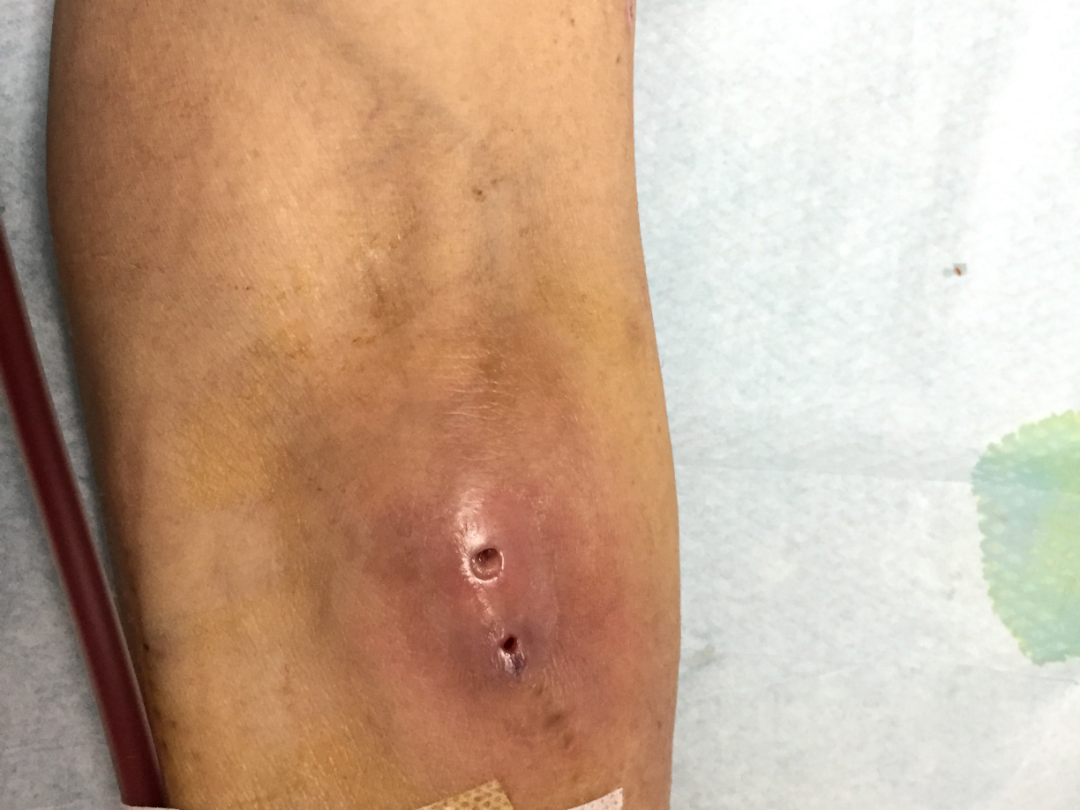 精准施策解难题，微创巧建「生命通道」——阳逻院区肾内科团队为肾衰患者成功实施特殊内瘘成形术