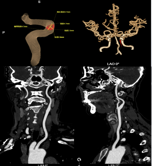 典型病例 |「沉默炸弹」现形记:一位中年女性与脑动脉瘤的影像学交锋