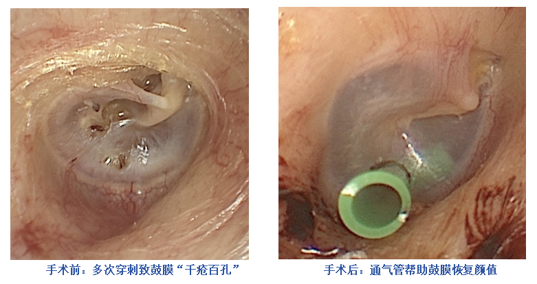 耳闷 + 听力暴跌!七旬奶奶多次治疗仍复发,真相竟藏在鼻子里…