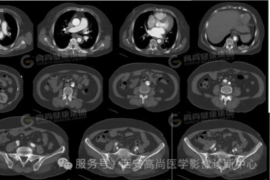 【高尚病例】生命通道的致命裂痕-主动脉夹层