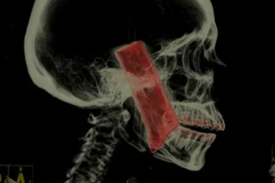 险！5×10 cm 刀片穿颅入脑……