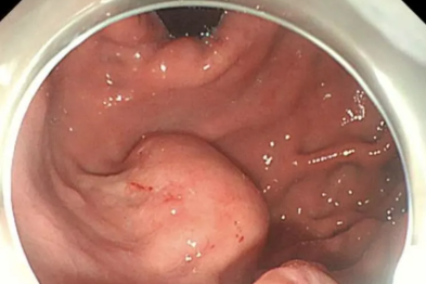 一次常规胃镜，竟查出体内「埋」了颗 5 厘米肿瘤！消化内镜专家如何「无痕拆除」？