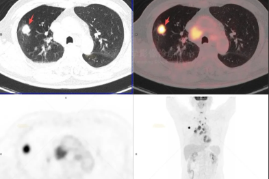 【高尚病例】咳嗽，伴胸痛，发现右肺上叶腺癌