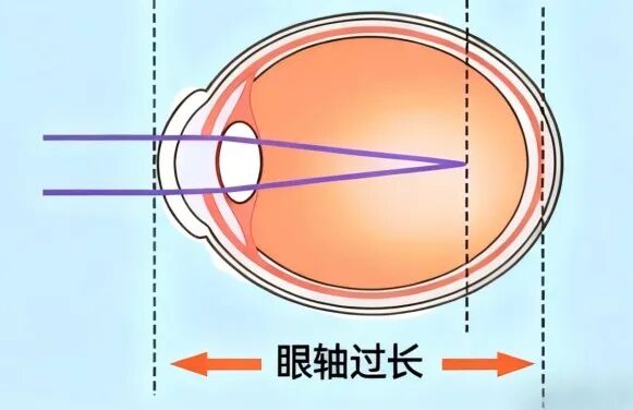 白内障提前到访?这类人尤其要警惕!