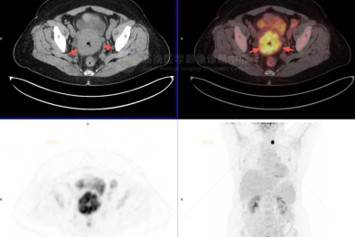 【高尚病例】绝经后阴道不规则流血，确诊宫颈癌