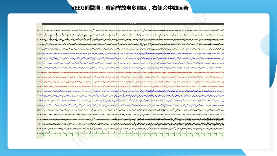 《「痫停」信步》癫痫治疗病例荟萃第四十一期---大脑半球离断术治疗 Rasmussen 脑炎引起的难治性癫痫一例