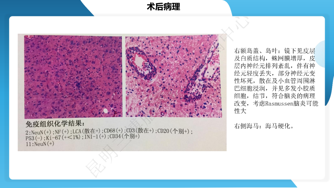 《「痫停」信步》癫痫治疗病例荟萃第四十一期---大脑半球离断术治疗 Rasmussen 脑炎引起的难治性癫痫一例