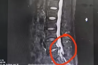 「放电」疼痛把患者「绑架」？脊柱科中医治疗+微创「魔法」让他行走自由……