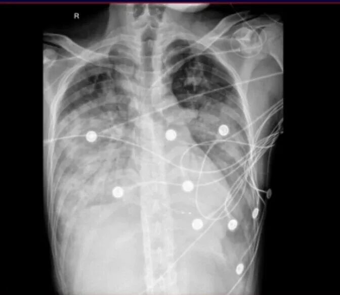 漳州 30 岁男子感冒硬扛 4 天,竟进 ICU 抢救!