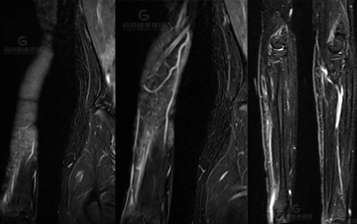 【高尚病例】神经纤维瘤病的影像表现