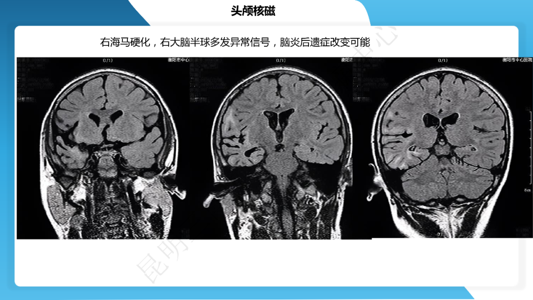 《「痫停」信步》癫痫治疗病例荟萃第四十一期---大脑半球离断术治疗 Rasmussen 脑炎引起的难治性癫痫一例