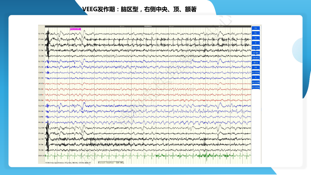 《「痫停」信步》癫痫治疗病例荟萃第四十一期---大脑半球离断术治疗 Rasmussen 脑炎引起的难治性癫痫一例