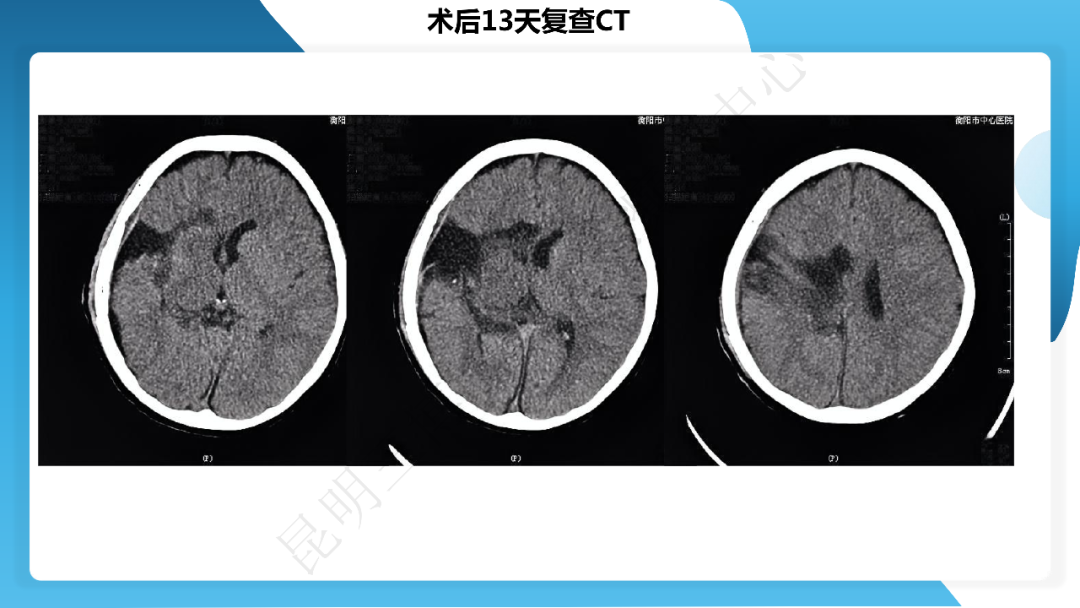 《「痫停」信步》癫痫治疗病例荟萃第四十一期---大脑半球离断术治疗 Rasmussen 脑炎引起的难治性癫痫一例