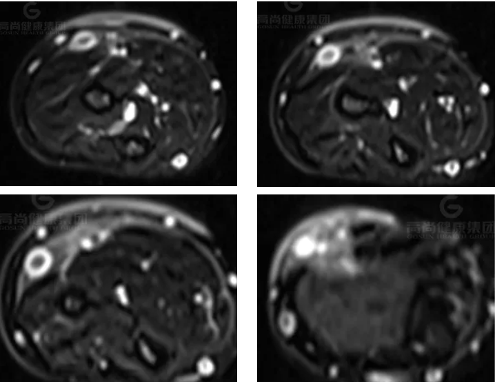 【高尚病例】神经纤维瘤病的影像表现