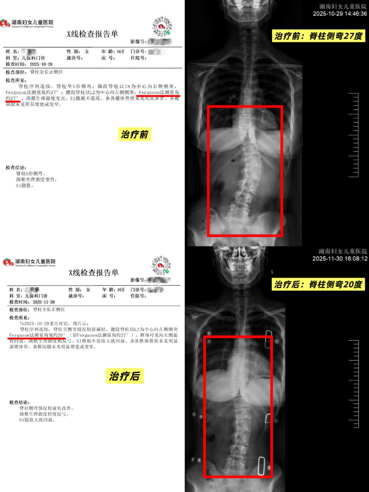 16 岁女孩查出脊柱侧弯 27 度!妈妈做出一个决定...