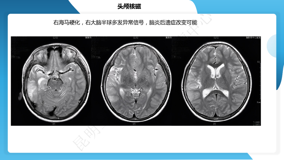 《「痫停」信步》癫痫治疗病例荟萃第四十一期---大脑半球离断术治疗 Rasmussen 脑炎引起的难治性癫痫一例