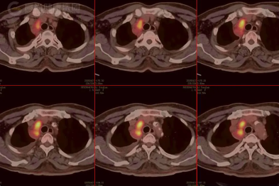 【高尚病例】揭开数年纵隔肿大淋巴结的神秘面纱——POEMS 综合征