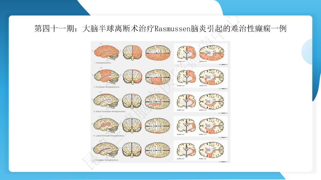 《「痫停」信步》癫痫治疗病例荟萃第四十一期---大脑半球离断术治疗 Rasmussen 脑炎引起的难治性癫痫一例