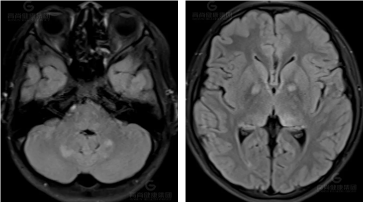 【高尚病例】神经纤维瘤病的影像表现