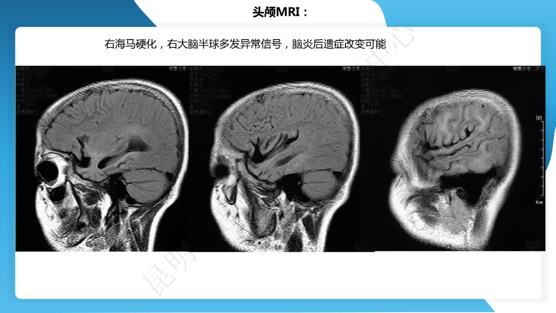 《「痫停」信步》癫痫治疗病例荟萃第四十一期---大脑半球离断术治疗 Rasmussen 脑炎引起的难治性癫痫一例