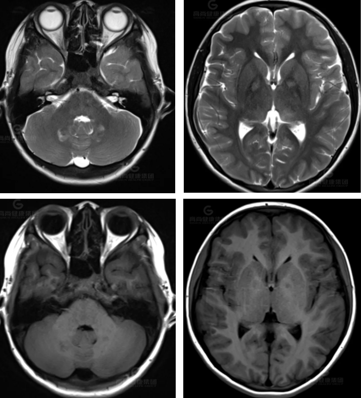 【高尚病例】神经纤维瘤病的影像表现