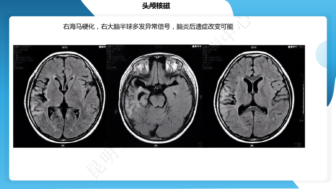 《「痫停」信步》癫痫治疗病例荟萃第四十一期---大脑半球离断术治疗 Rasmussen 脑炎引起的难治性癫痫一例