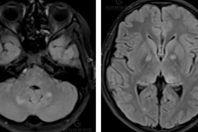 【高尚病例】神经纤维瘤病的影像表现