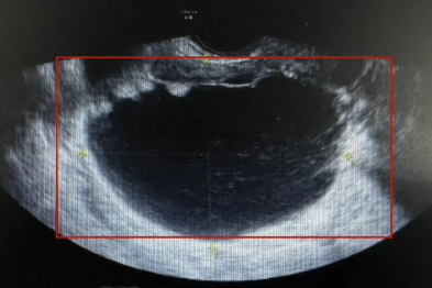 60 岁阿姨「怀孕」数年，竟「产」下 20 多斤的……
