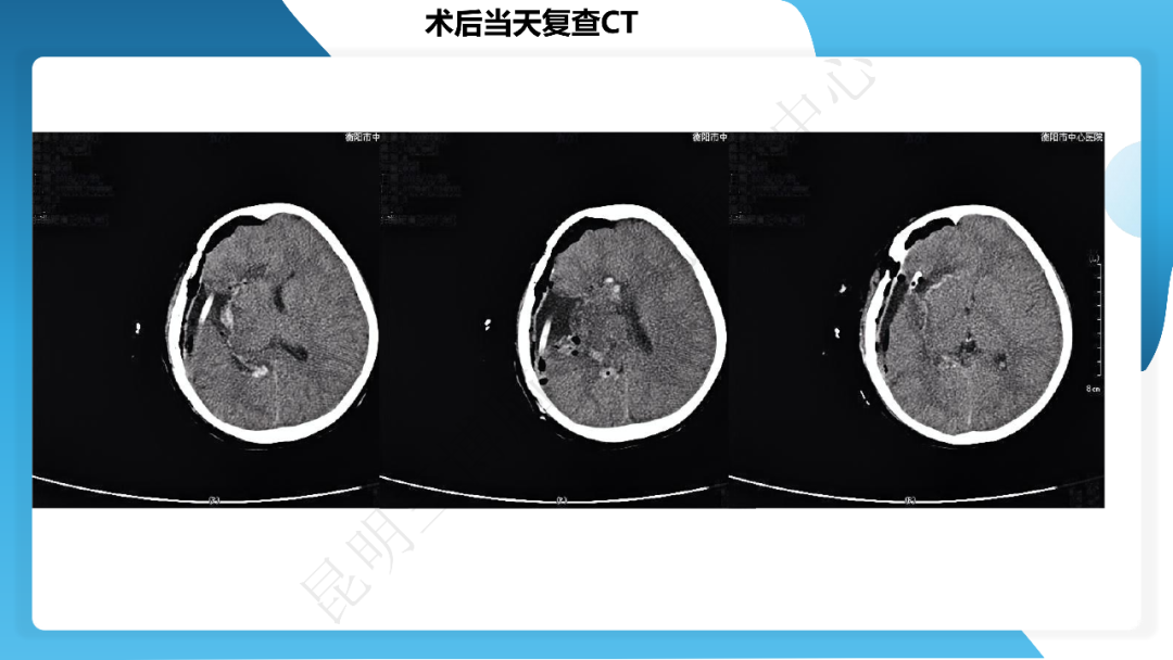 《「痫停」信步》癫痫治疗病例荟萃第四十一期---大脑半球离断术治疗 Rasmussen 脑炎引起的难治性癫痫一例