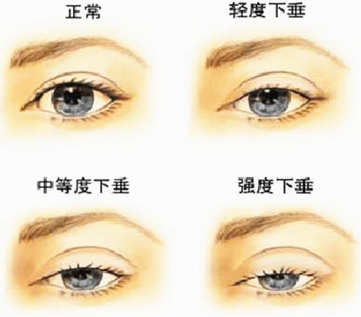 孩子有上睑下垂该怎么治疗?武汉普瑞眼科李强科普手术矫正方式