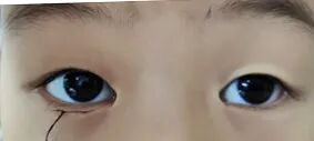 孩子有上睑下垂该怎么治疗?武汉普瑞眼科李强科普手术矫正方式