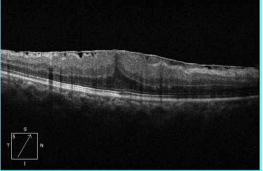 黄斑前膜该怎么治疗?武汉普瑞眼科许泽骏科普症状和手术治疗方式