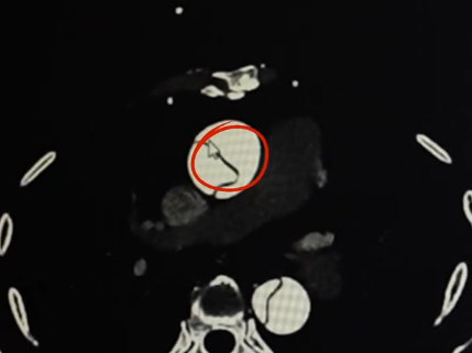 48 小时 3 例主动脉夹层!浙大四院张总刚团队与「死神」竞速,守护心脏大血管
