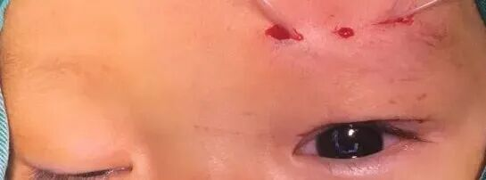孩子有上睑下垂该怎么治疗?武汉普瑞眼科李强科普手术矫正方式