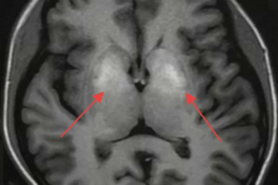 20 岁女孩身体不受控「舞蹈」！就医前每天只吃一顿