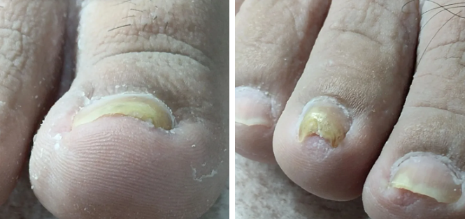 灰指甲、甲沟炎别硬扛！正兴医院科学治疗守护指甲健康！