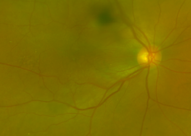 黄斑前膜该怎么治疗?武汉普瑞眼科许泽骏科普症状和手术治疗方式